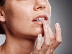 cold sore prevention