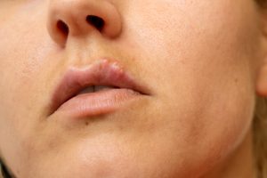 Cold Sore Prevention